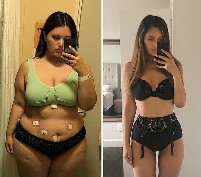 Girl before and after weight loss with capsule KETO Complete